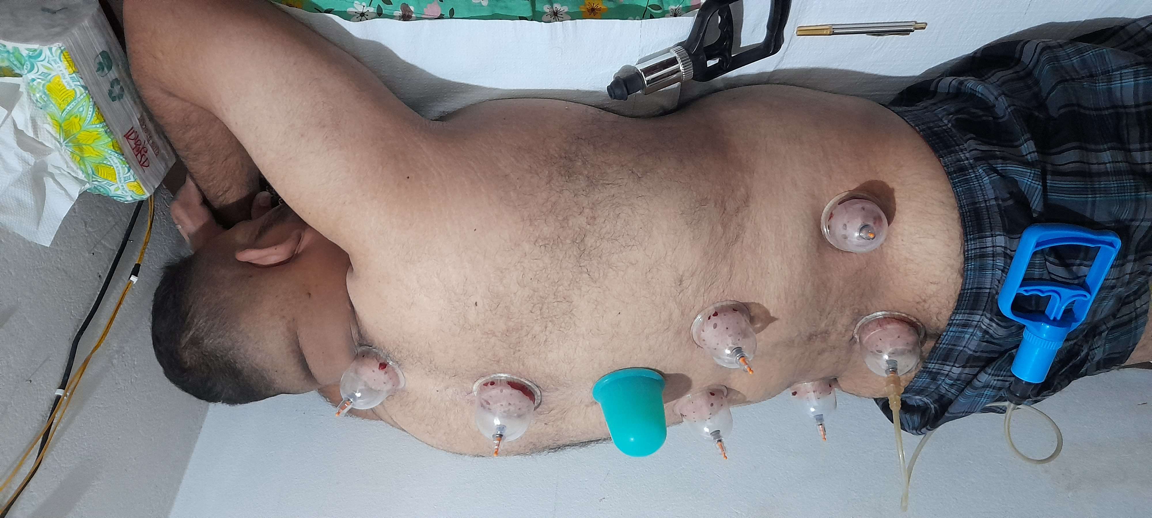 Hijama therapy